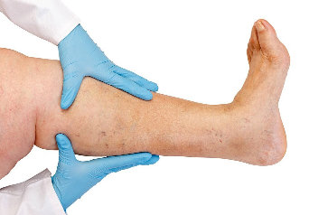 Hannover used to treat varicose veins, thrombosis, concomitant disease