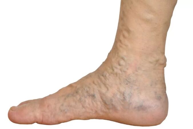 Veen's diseases