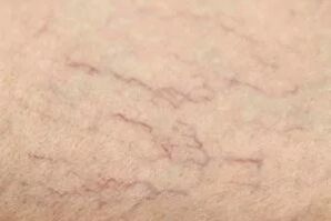 Vascular stars