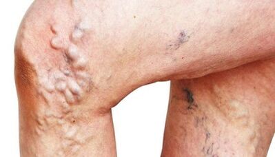 The main manifestations of varicose veins of the legs