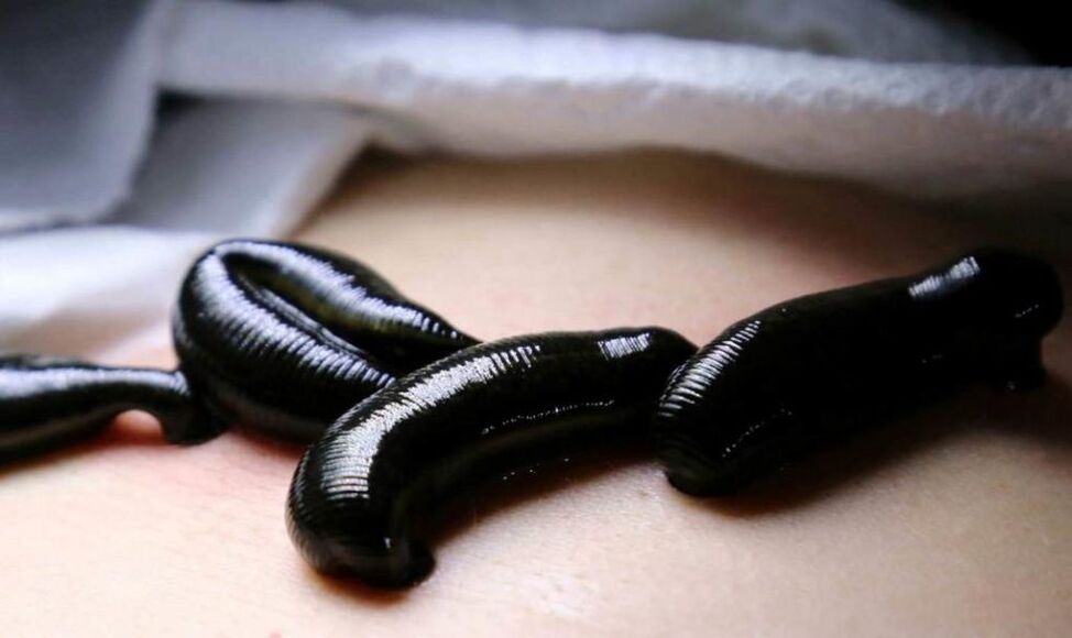 Treatment of varicose veins with leeches