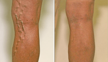 varicose veins at stages 1 and 3 of development