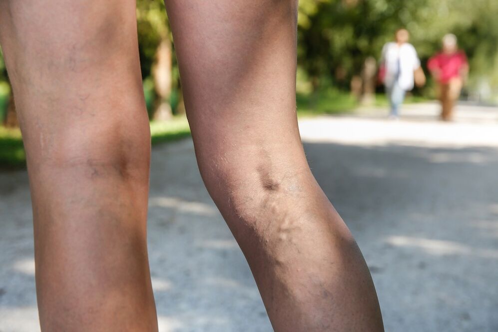 varicose veins on the legs