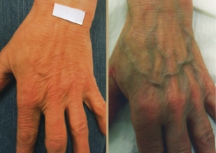 causes of varicose veins of the hands