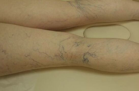 Different stars of the legs