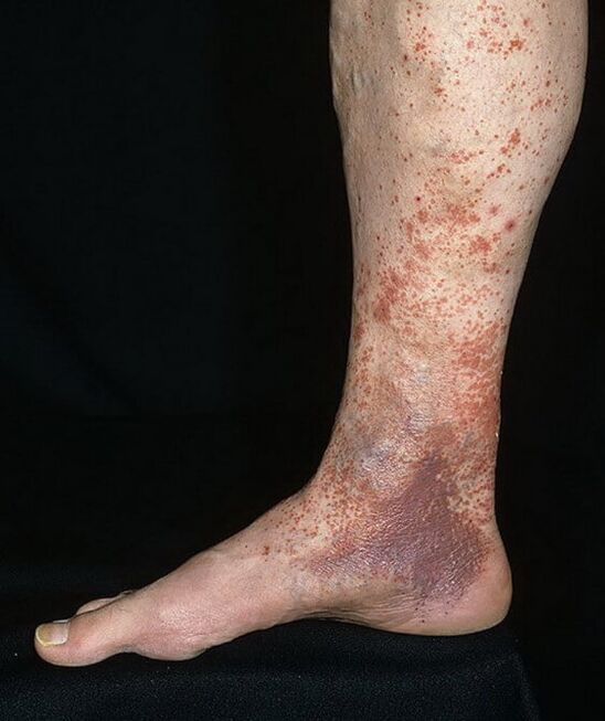 Varicose dermatitis