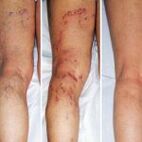 Varicose veins in the legs