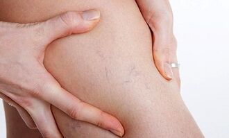 causes of the development of varicose veins in the legs