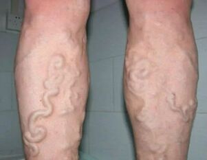 Varicose veins of the legs of 3 degrees