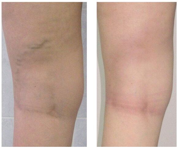 vein in the leg before and after treatment of varicose veins