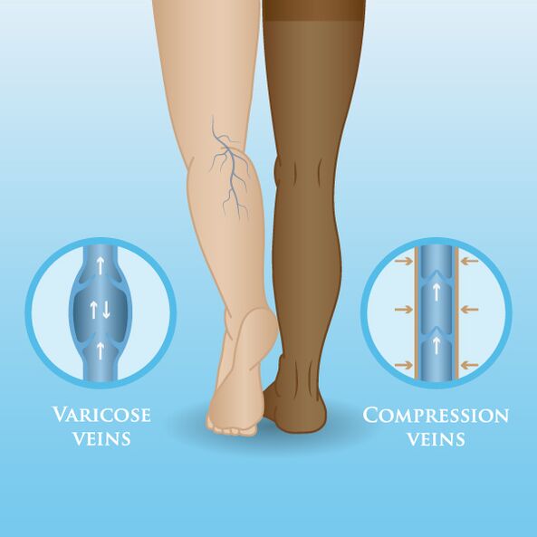 Effects of compression garments on varicose veins of the legs