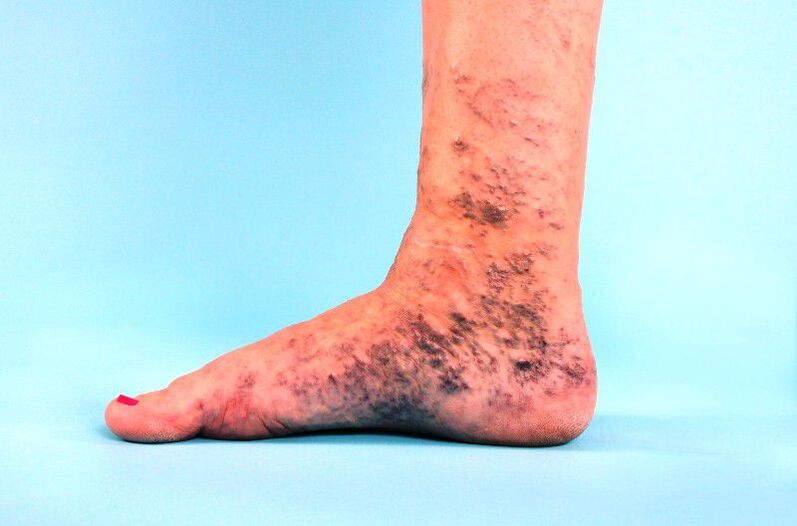 neglected varicose veins of the legs