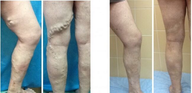 Legs before and after radiofrequency deletion of varicose veins