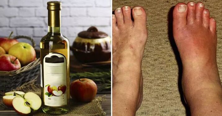 apple cider vinegar for swelling of the legs
