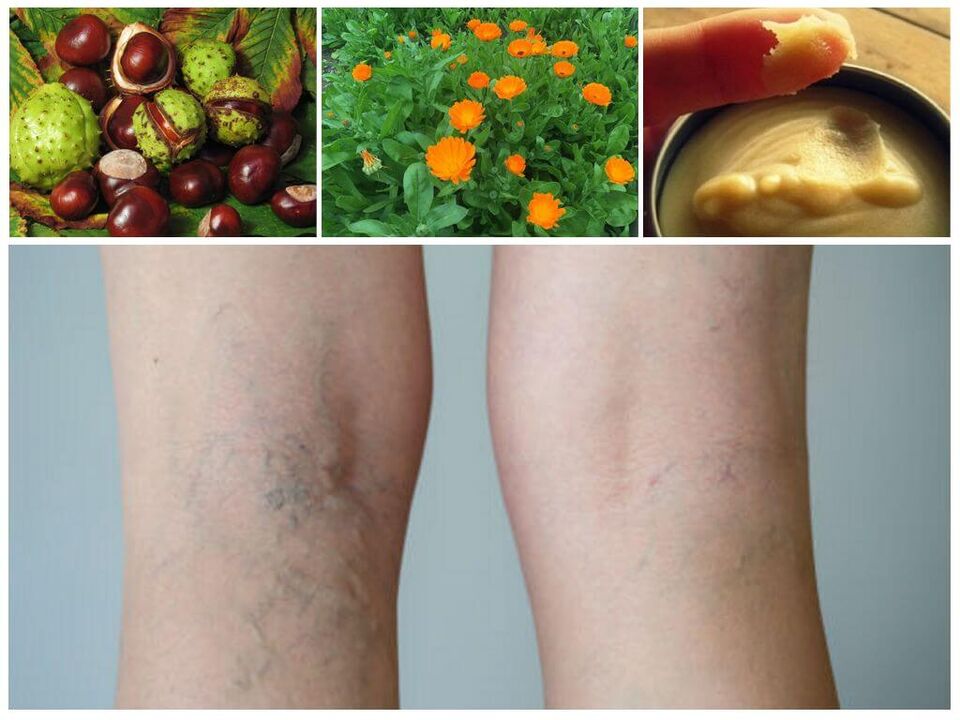 varicose veins of the legs and folk remedies for its prevention