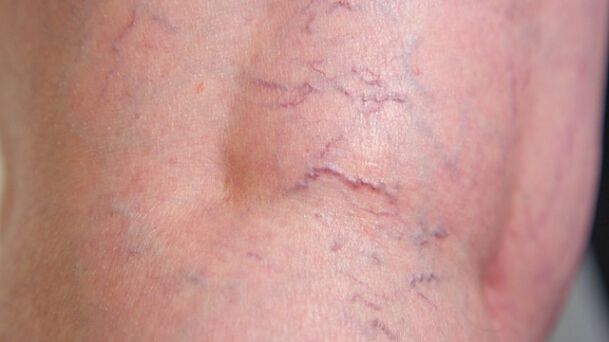 Signs of reticular varicose veins of the lower extremities - varicose veins and vascular network