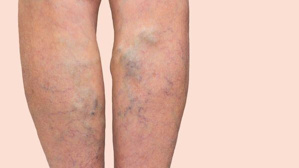 varicose veins of the legs