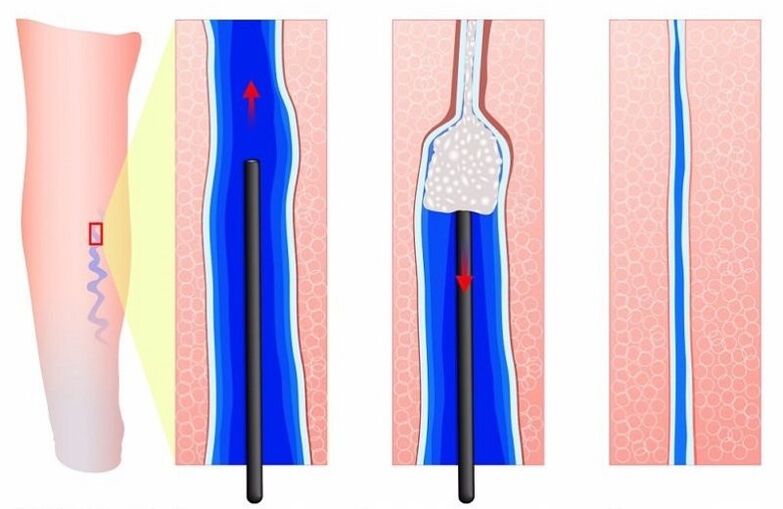 sclerotherapy for varicose veins of the legs in men