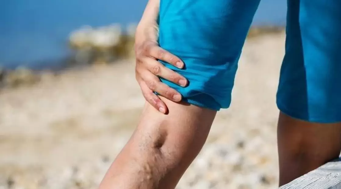 Protruding blue veins in the legs are a sign of varicose veins
